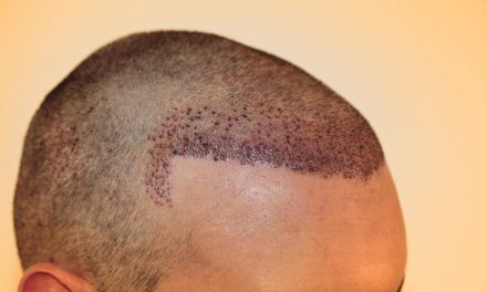 Prosedur Penanam Rambut Ketika Mengalami Kebotakan