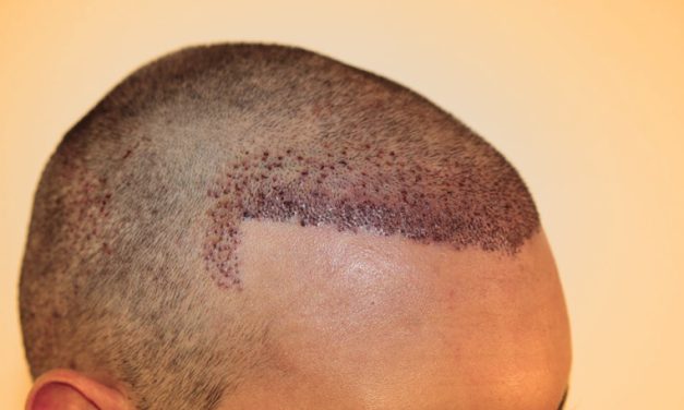 Prosedur Penanam Rambut Ketika Mengalami Kebotakan