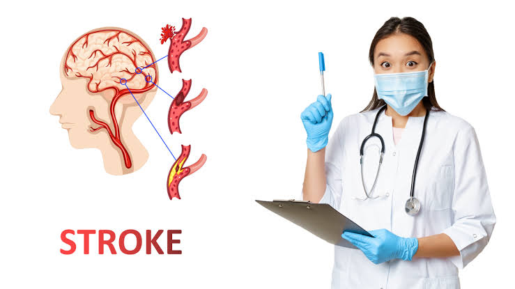 Kondisi Serius Stroke Pada Medis Harus Di Obati